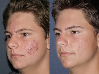 Photodynamic therapy and Fraxel Restore before 614333