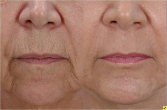 Fractional Resurfacing before 230841