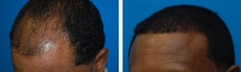 Hair Transplant Before & After - 46 Year-Old Male, 2600 Grafts, 20 Months Post Op 910208