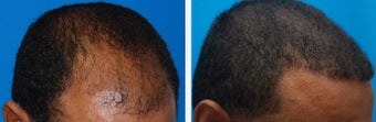 Hair Transplant Before & After - 46 Year-Old Male, 2600 Grafts, 20 Months Post Op after 910208