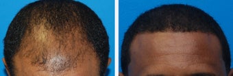 Hair Transplant Before & After - 46 Year-Old Male, 2600 Grafts, 20 Months Post Op before 910208