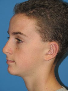 Otoplasty Ear Surgery - Boy 818060