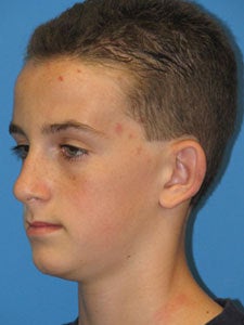 Otoplasty Ear Surgery - Boy 818060