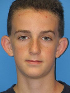 Otoplasty Ear Surgery - Boy before 818060