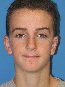 Otoplasty Ear Surgery - Boy after 818060