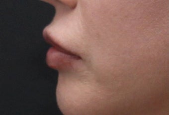 Lip Implant 406789