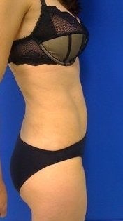 Laser Liposuction 561209