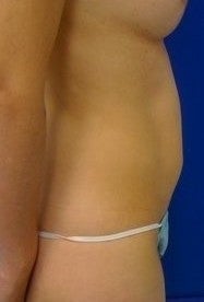 Laser Liposuction 561209