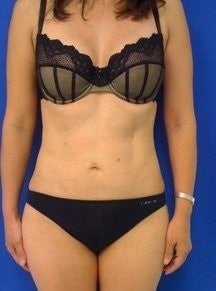 Laser Liposuction after 561209