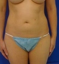 Laser Liposuction before 561209