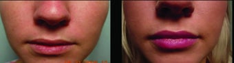 Restylane before 460608
