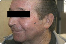 Pixel Laser after 207825