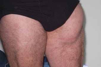 Lipoma Removal before 611268