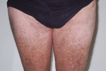 Lipoma Removal after 611268