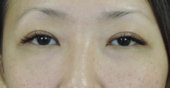 Asian eyelid surgery for excess skin after 1130667