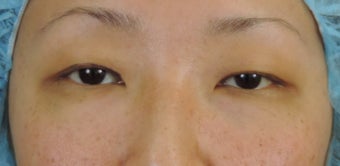 Asian eyelid surgery for excess skin before 1130667