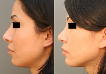 Beverly HIlls/Los Angeles Primary Rhinoplasty before 642696