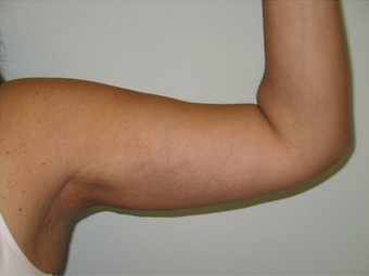 Arm Lift after 535915