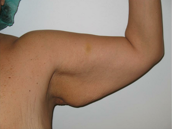 Arm Lift before 535915