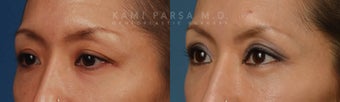 Before and After Upper and Lower Eyelid Blepharoplasty Surgery before 714172