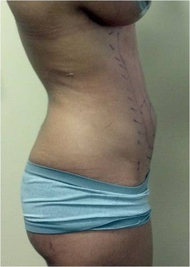 Laser Liposuction 561155