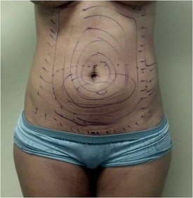Laser Liposuction before 561155