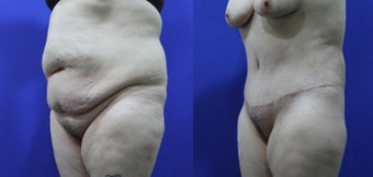 46 Year Old Treated for Abdominal Apron & Sagging Buttocks before 1109104