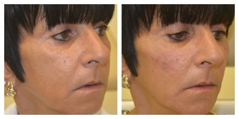 Middle Aged Female Treated for Middle Face Volume Loss and Cheek Contouring after 1367273