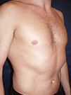 Pec Implants 887762