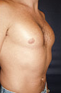 Pec Implants 887762