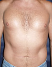 Pec Implants after 887762