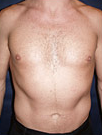 Pec Implants before 887762