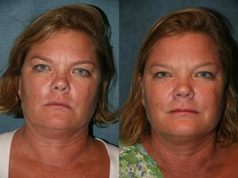 Ultherapy 420022