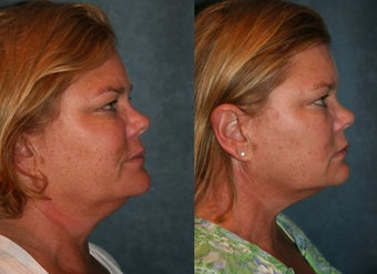 Ultherapy 420022