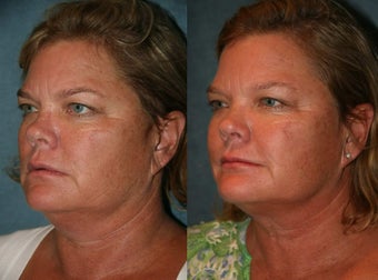 Ultherapy after 420022