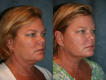 Ultherapy before 420022