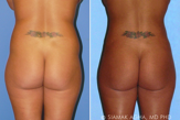 Liposuction before 217837