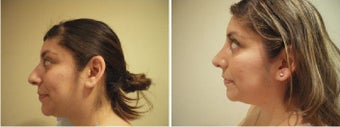 Rhinoplasty before 172969