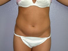 Liposuction before 677493