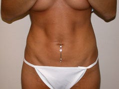 Liposuction after 677493