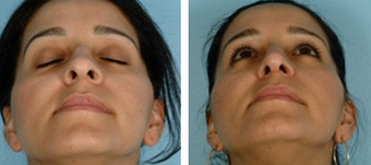 Functional Rhinoplasty before 1208315