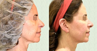 Ultherapy before 657908