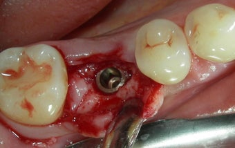 Before and After Case for Dental Implants 887625