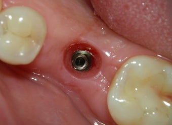Before and After Case for Dental Implants before 887625