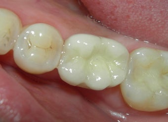 Before and After Case for Dental Implants 887625