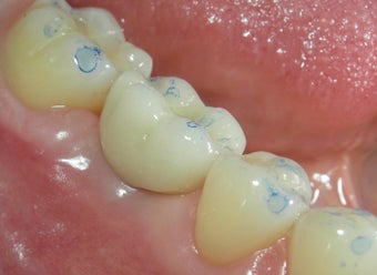 Before and After Case for Dental Implants after 887625