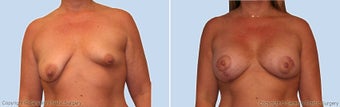 breast lift before 530090