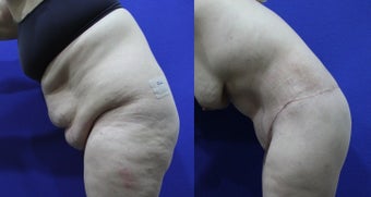 46 Year Old Treated for Abdominal Apron & Sagging Buttocks before 1109102