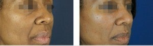 Fillers To Cheeks after 928968