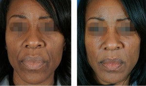 Fillers To Cheeks before 928968